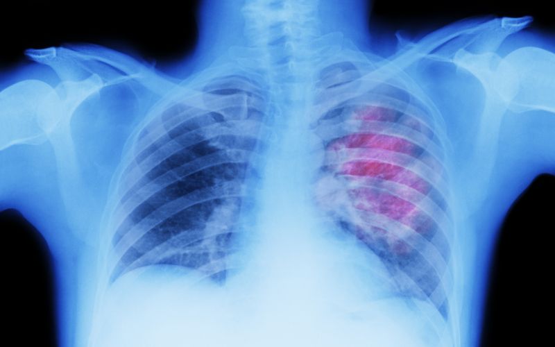 BBC Mundo Cáncer Síntomas