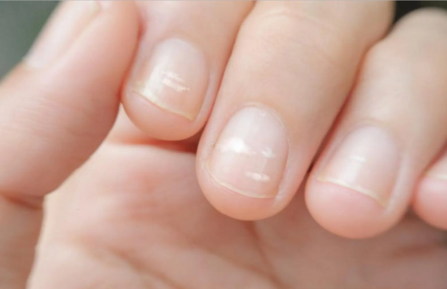 ¿Las manchitas blancas de las uñas son por falta de calcio?