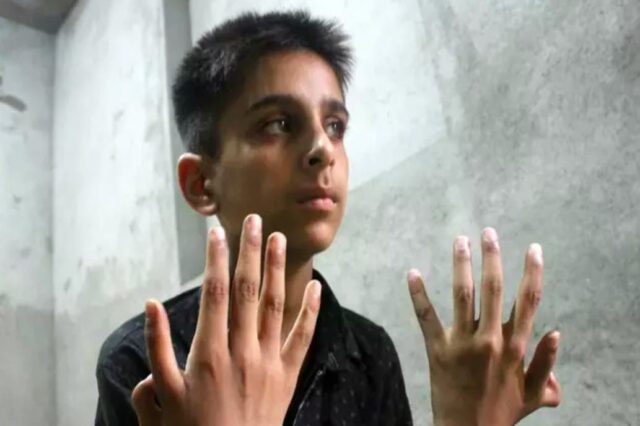Nació con cuatro pulgares y sueña con estudiar medicina para ayudar a otros