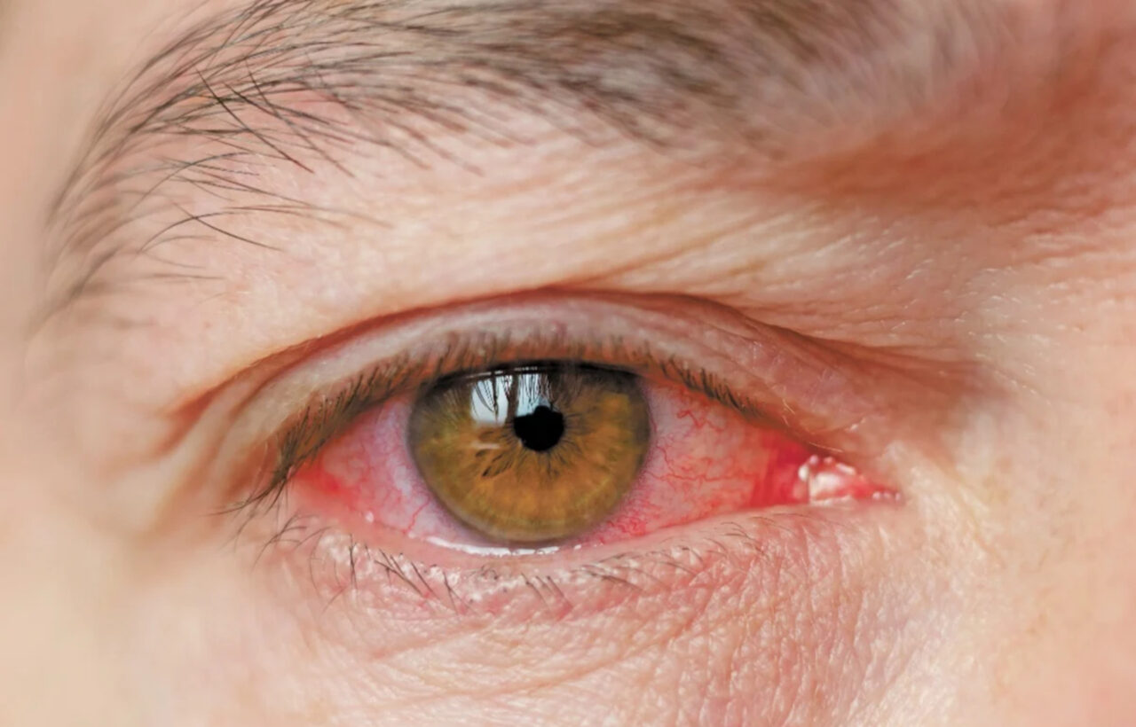 conjuntivitis