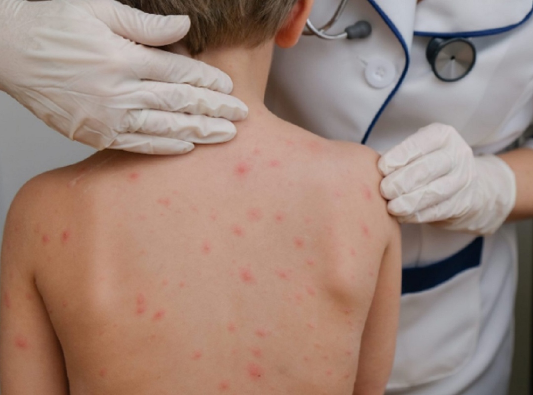 médicos viruela de mono
