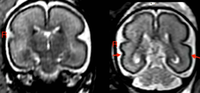Beber en el embarazo, incluso poco, produce cambios en el cerebro del bebé
