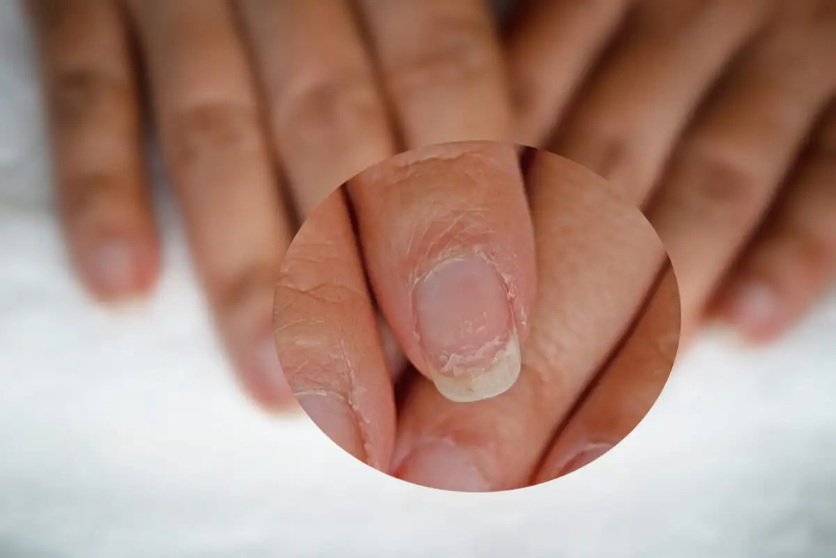 Uñas rotas