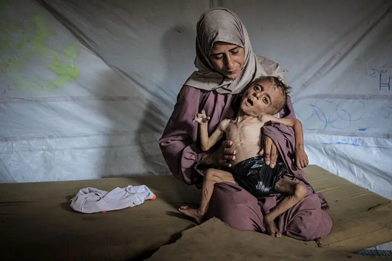 El Ministerio de Sanidad de Gaza informó 122 muertes de palestinos por desnutrición. Getty Images