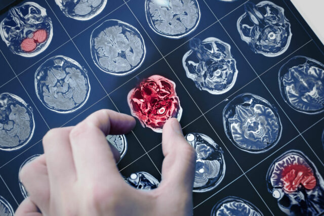Qué es un glioma, el agresivo cáncer cerebral que se cobró la vida de la actriz Kelley Mack