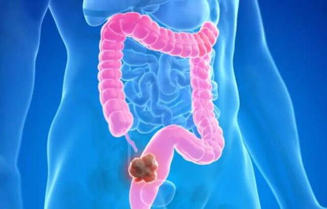 El "dúo mortal" del intestino que multiplica por cinco el riesgo de cáncer