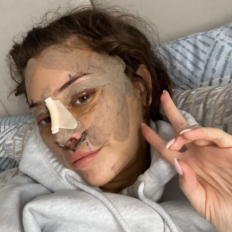 ¿Un "lifting" a los 28? Por qué cada vez hay más jóvenes que recurren a la cirugía plástica